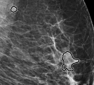Hologic ImageChecker™ 2D CAD Technology